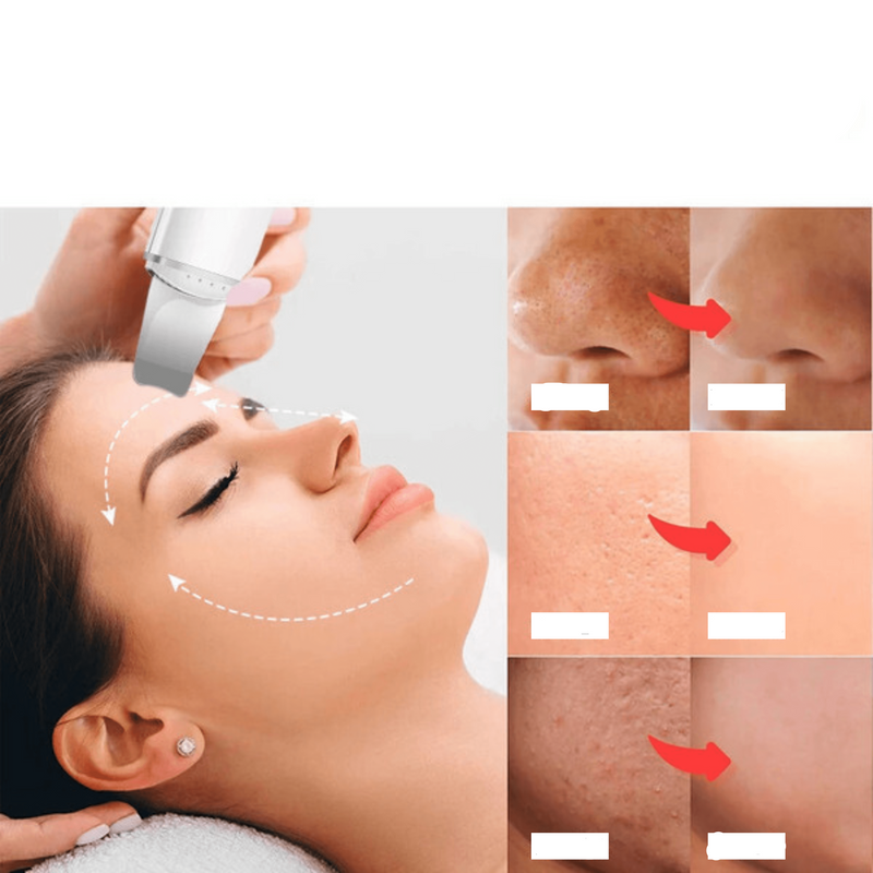 Como Usar o Esfoliador Ultrassônico para uma Limpeza de Pele Profunda em Casa
